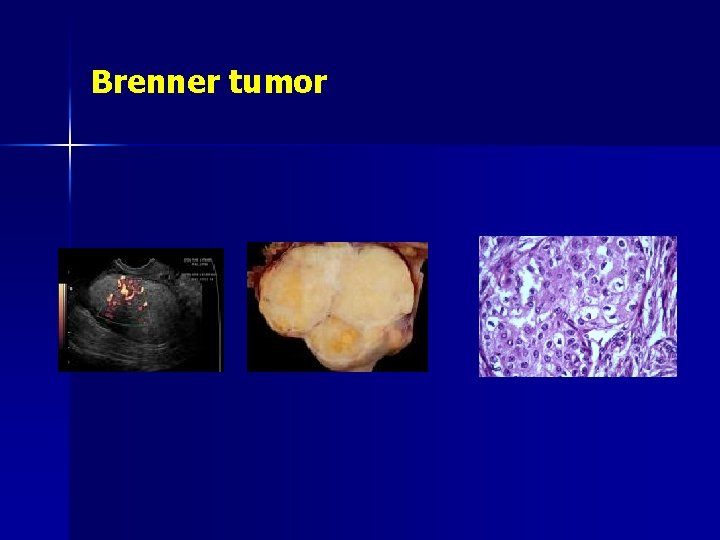 Brenner tumor 