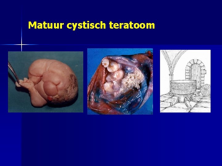 Matuur cystisch teratoom 