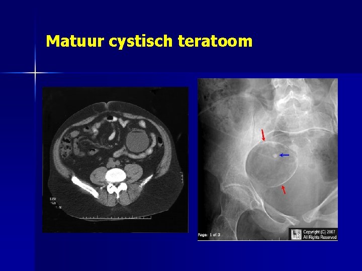 Matuur cystisch teratoom 
