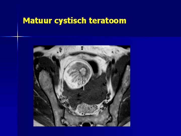 Matuur cystisch teratoom 