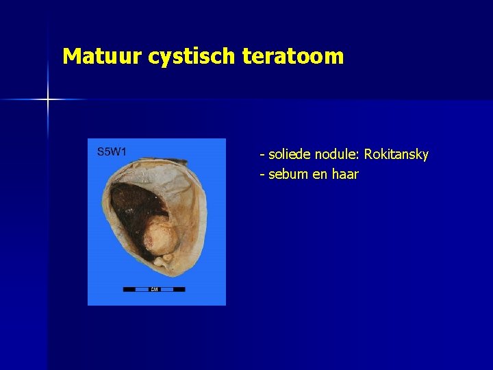 Matuur cystisch teratoom - soliede nodule: Rokitansky - sebum en haar 
