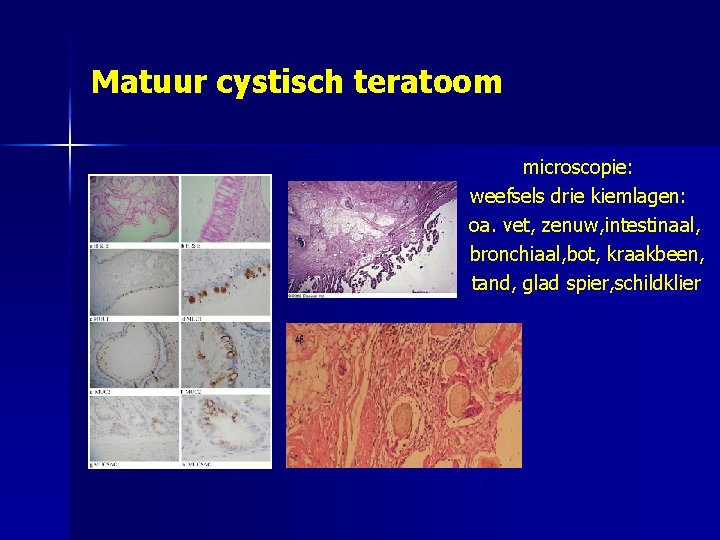 Matuur cystisch teratoom microscopie: weefsels drie kiemlagen: oa. vet, zenuw, intestinaal, bronchiaal, bot, kraakbeen,