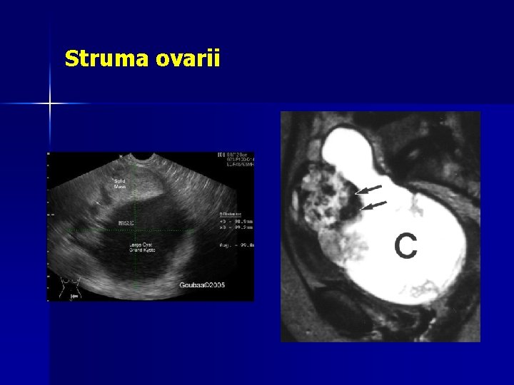 Struma ovarii 