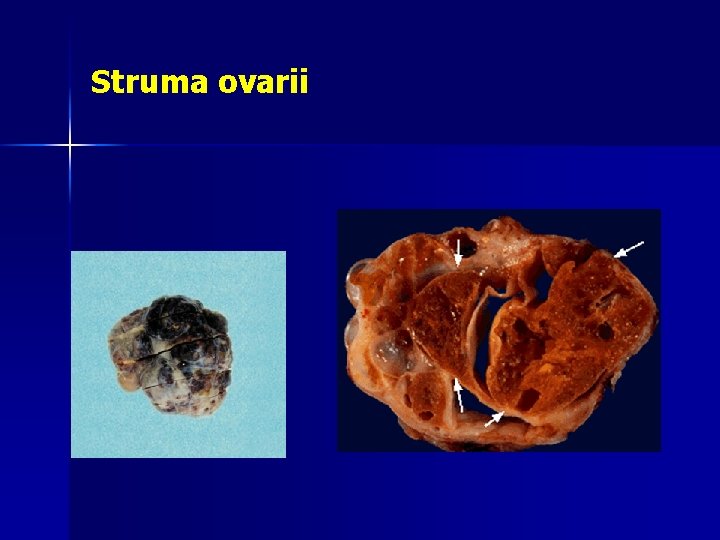 Struma ovarii 