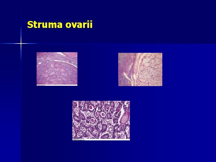 Struma ovarii 