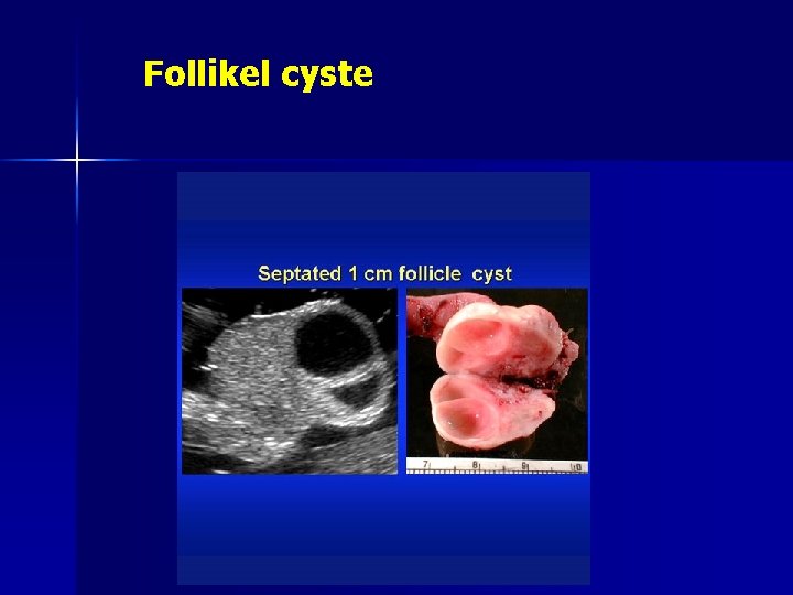 Follikel cyste 