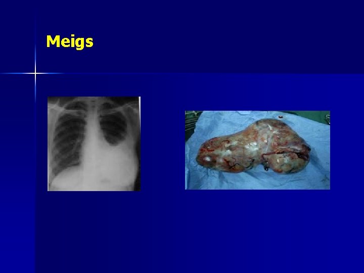 Meigs 