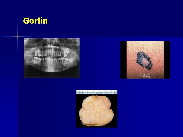 Gorlin 