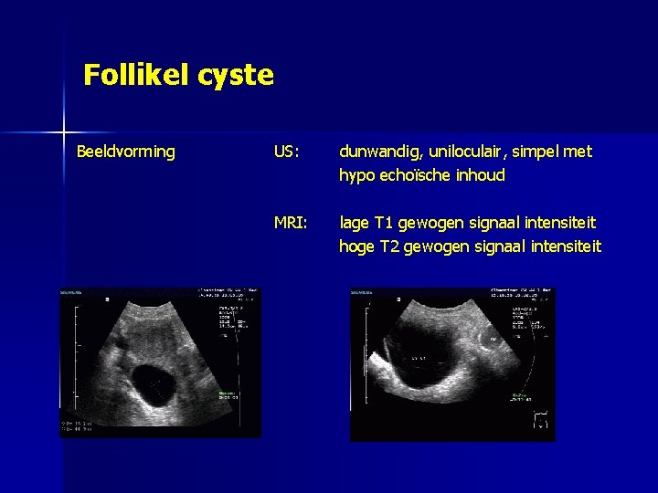 Follikel cyste Beeldvorming US: dunwandig, uniloculair, simpel met hypo echoïsche inhoud MRI: lage T