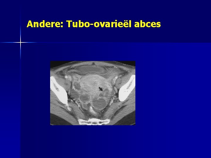 Andere: Tubo-ovarieël abces 