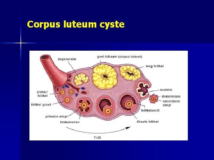 Corpus luteum cyste 