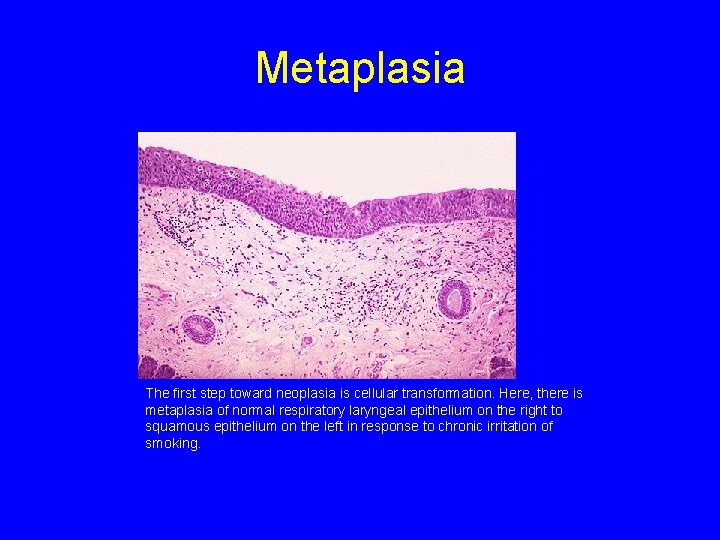 Metaplasia The first step toward neoplasia is cellular transformation. Here, there is metaplasia of