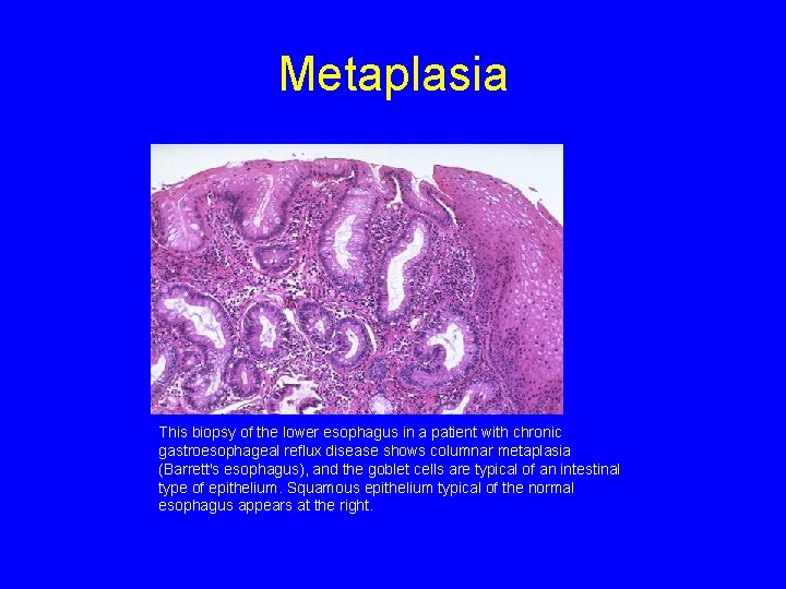 Metaplasia This biopsy of the lower esophagus in a patient with chronic gastroesophageal reflux