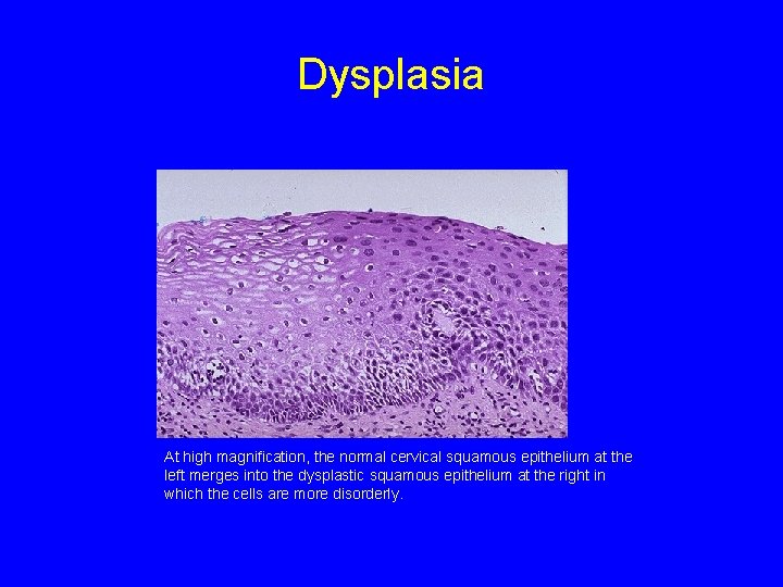Dysplasia At high magnification, the normal cervical squamous epithelium at the left merges into