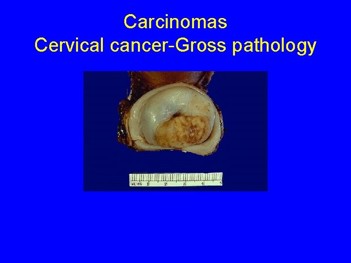 Carcinomas Cervical cancer-Gross pathology 