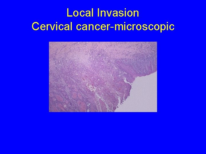 Local Invasion Cervical cancer-microscopic 