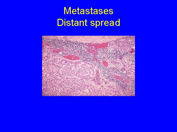 Metastases Distant spread 