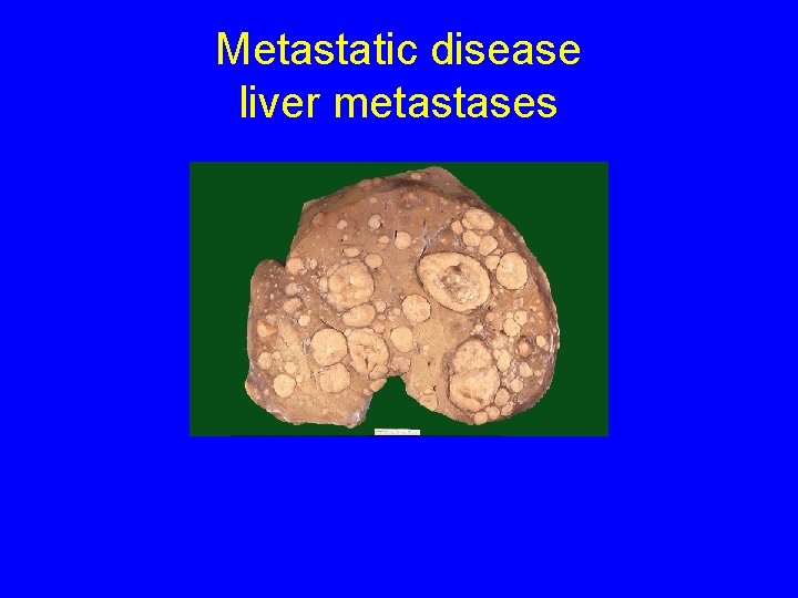 Metastatic disease liver metastases 