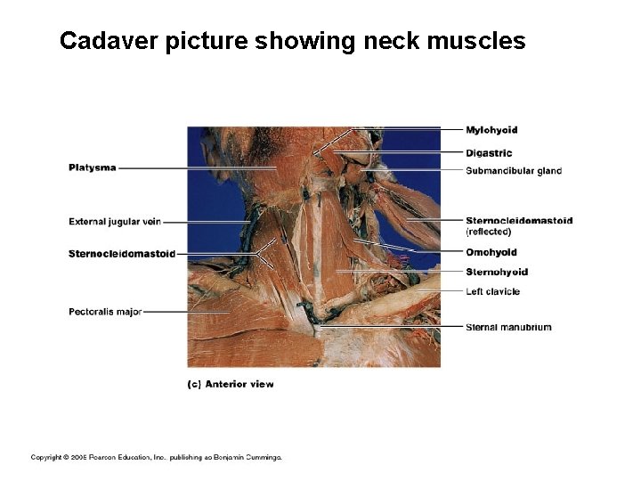 Cadaver picture showing neck muscles 