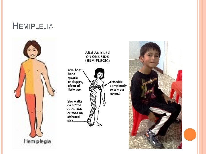 HEMIPLEJIA 
