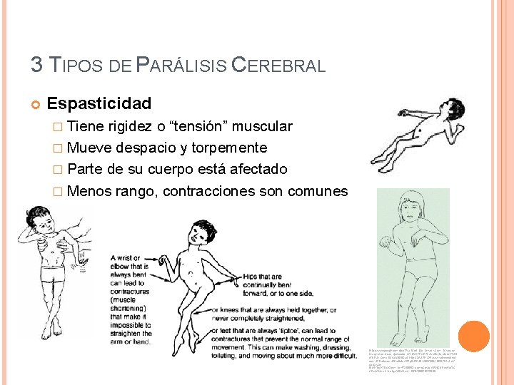 3 TIPOS DE PARÁLISIS CEREBRAL Espasticidad � Tiene rigidez o “tensión” muscular � Mueve