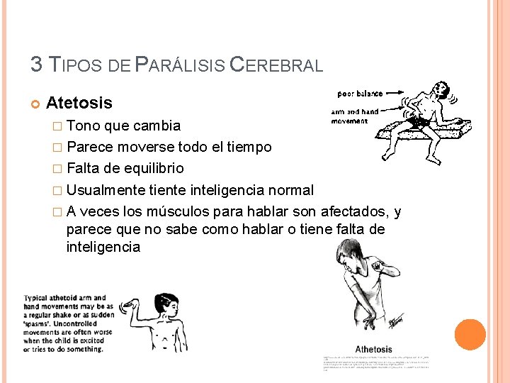 3 TIPOS DE PARÁLISIS CEREBRAL Atetosis � Tono que cambia � Parece moverse todo