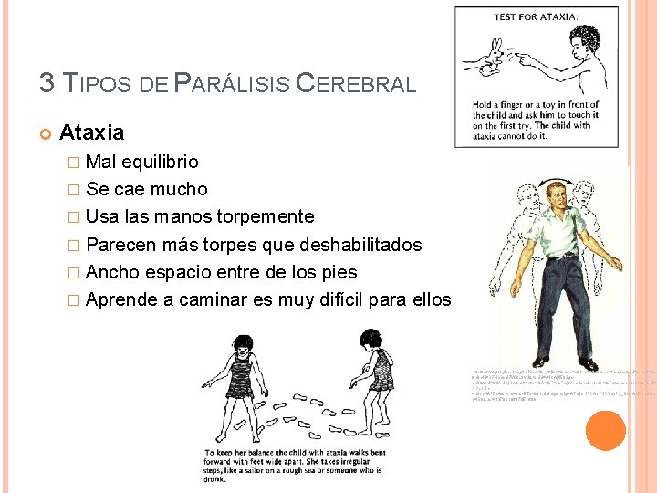 3 TIPOS DE PARÁLISIS CEREBRAL Ataxia � Mal equilibrio � Se cae mucho �