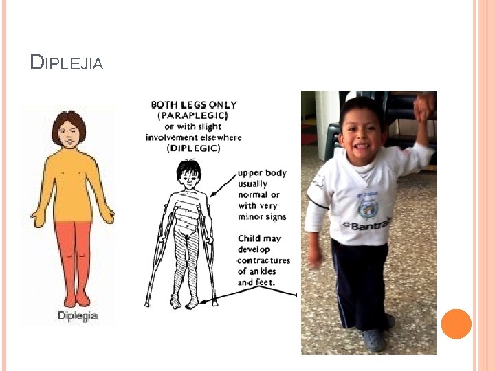 DIPLEJIA 
