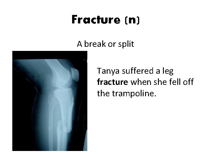 Fracture (n) A break or split Tanya suffered a leg fracture when she fell