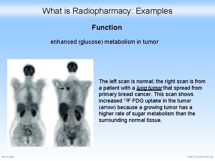 What is Radiopharmacy: Examples Function enhanced (glucose) metabolism in tumor The left scan is