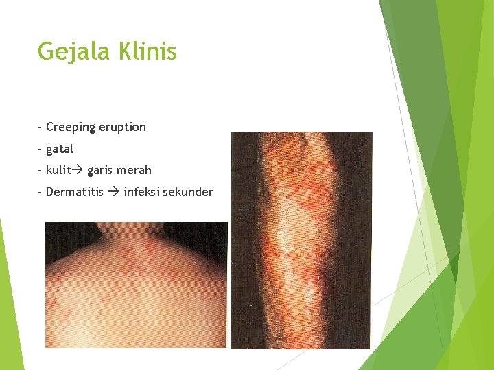 Gejala Klinis - Creeping eruption - gatal - kulit garis merah - Dermatitis infeksi