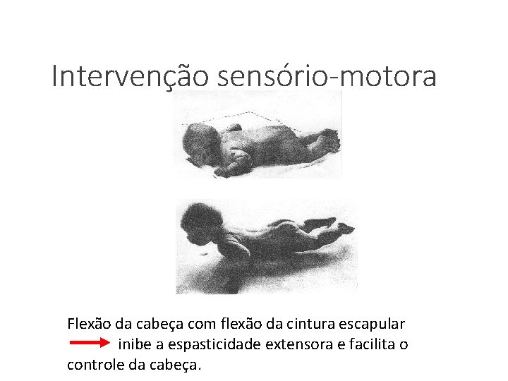 Intervenção sensório-motora Flexão da cabeça com flexão da cintura escapular inibe a espasticidade extensora