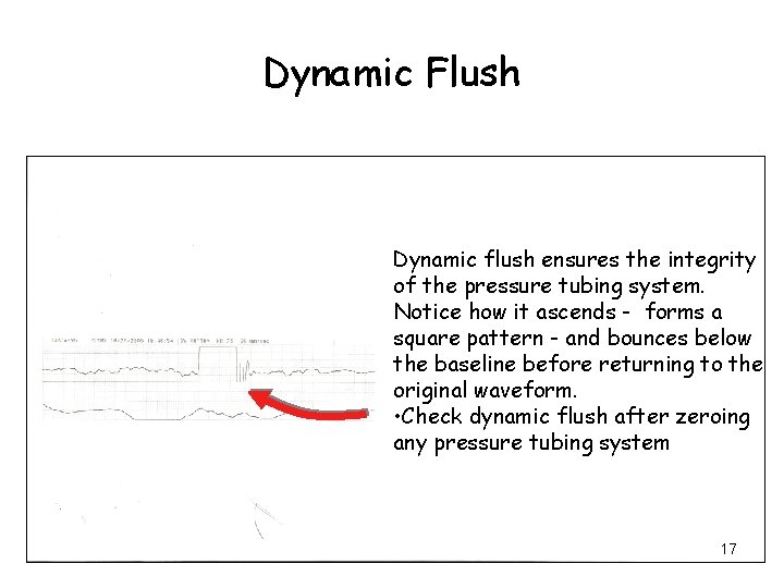 Dynamic Flush Dynamic flush ensures the integrity of the pressure tubing system. Notice how