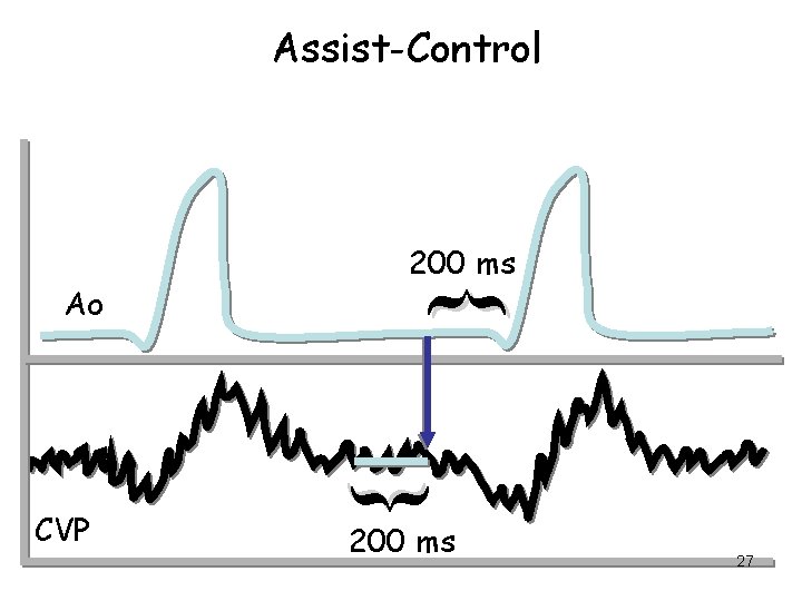 Assist-Control { CVP { Ao 200 ms 27 