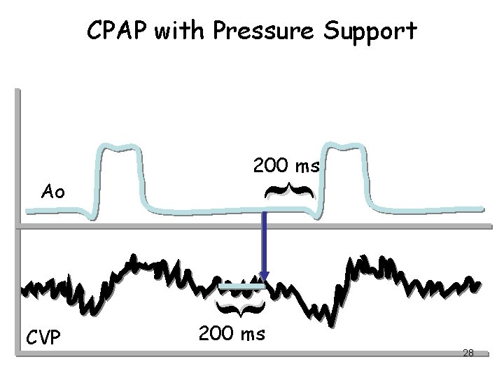 CPAP with Pressure Support { { Ao 200 ms CVP 200 ms 28 