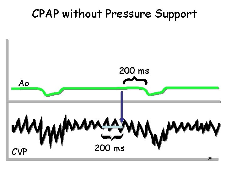 CPAP without Pressure Support { { Ao 200 ms CVP 200 ms 29 