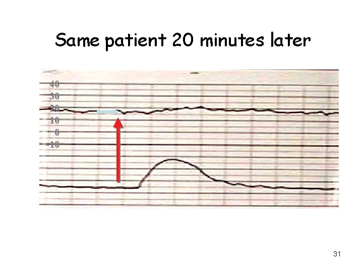 Same patient 20 minutes later 4040 3030 2020 1010 00 -10 31 