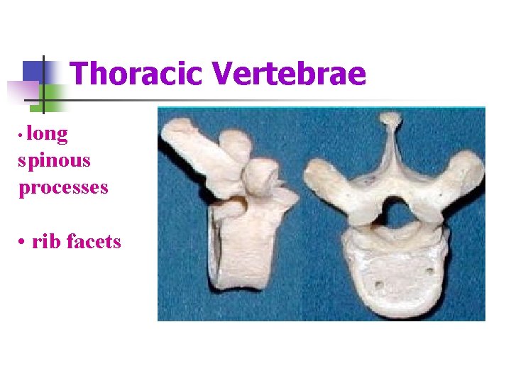 Thoracic Vertebrae • long spinous processes • rib facets 