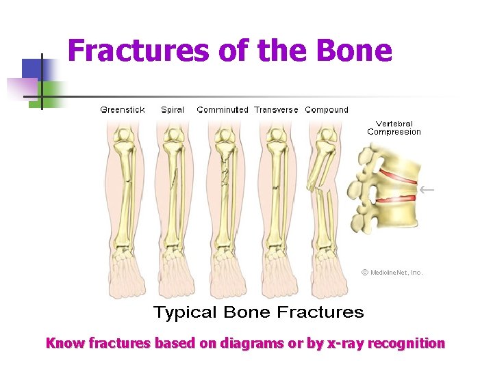 Fractures of the Bone Know fractures based on diagrams or by x-ray recognition 