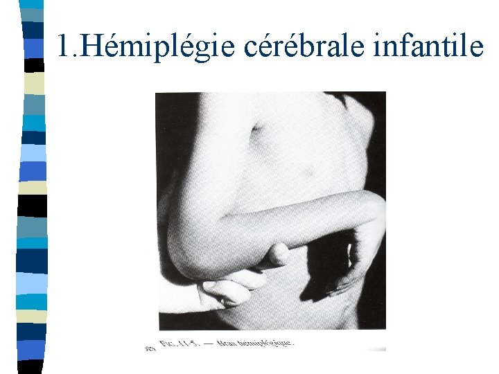 1. Hémiplégie cérébrale infantile 
