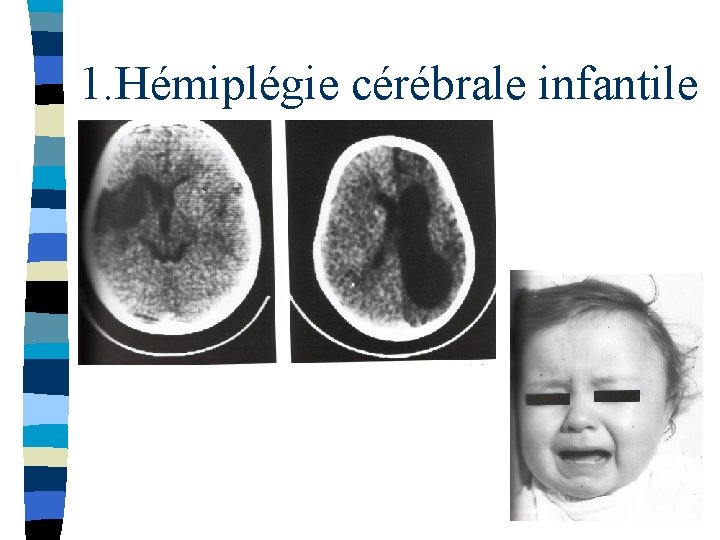 1. Hémiplégie cérébrale infantile 
