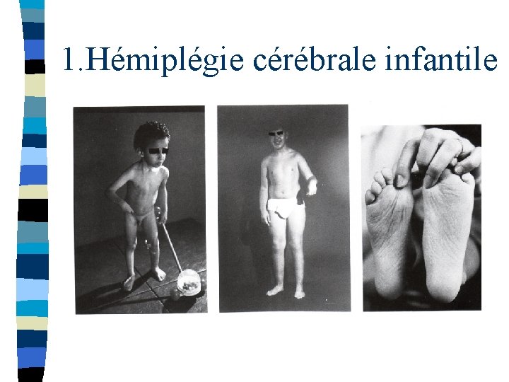 1. Hémiplégie cérébrale infantile 