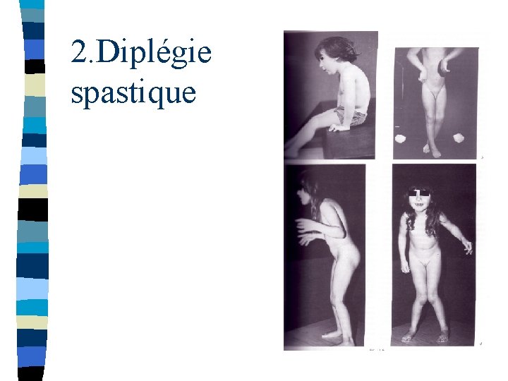 2. Diplégie spastique 