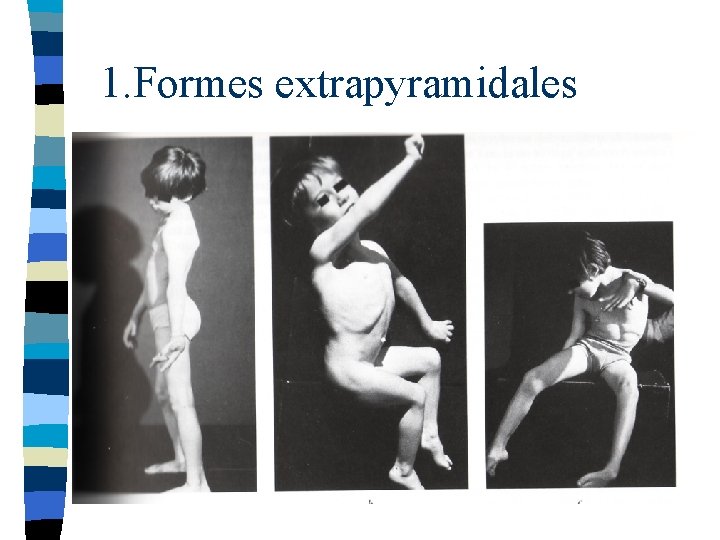 1. Formes extrapyramidales 