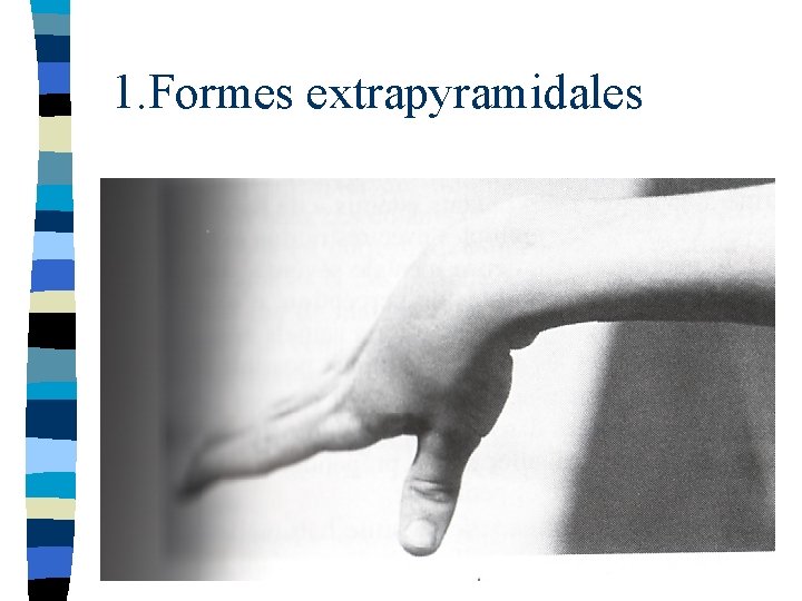 1. Formes extrapyramidales 