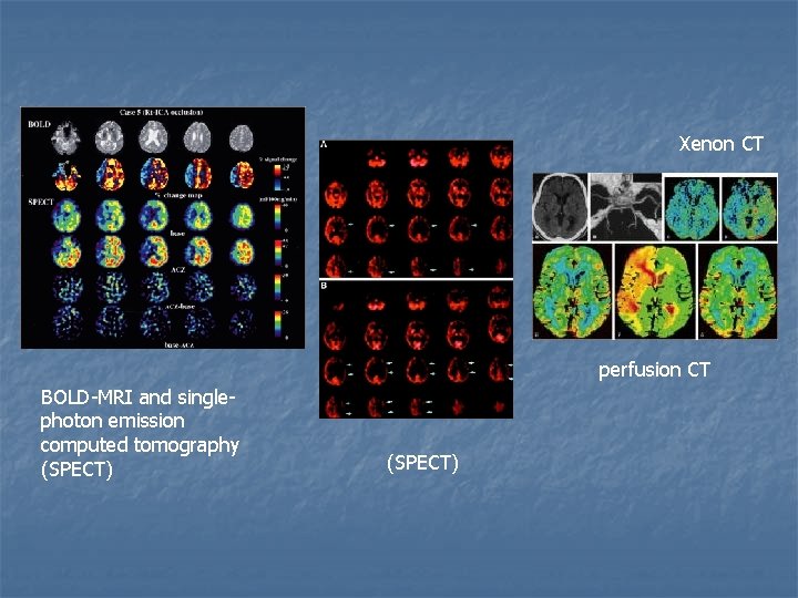 Xenon CT perfusion CT BOLD-MRI and singlephoton emission computed tomography (SPECT) 