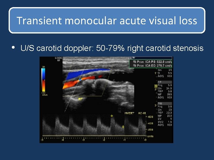 Transient monocular acute visual loss • U/S carotid doppler: 50 -79% right carotid stenosis Transient monocular acute visual loss • U/S carotid doppler: 50 -79% right carotid stenosis