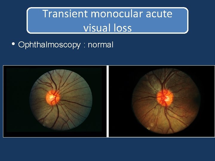 Transient monocular acute visual loss • Ophthalmoscopy : normal Transient monocular acute visual loss • Ophthalmoscopy : normal