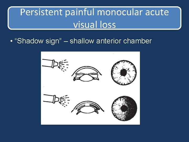 Persistent painful monocular acute visual loss • “Shadow sign” – shallow anterior chamber Persistent painful monocular acute visual loss • “Shadow sign” – shallow anterior chamber