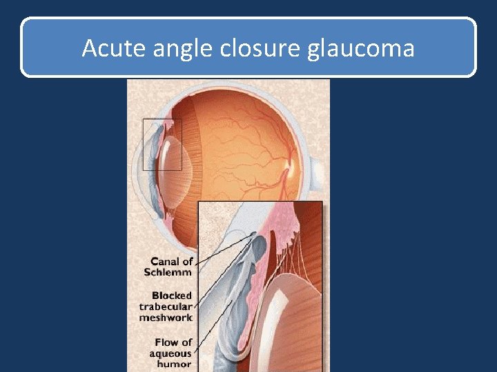 Acute angle closure glaucoma Acute angle closure glaucoma